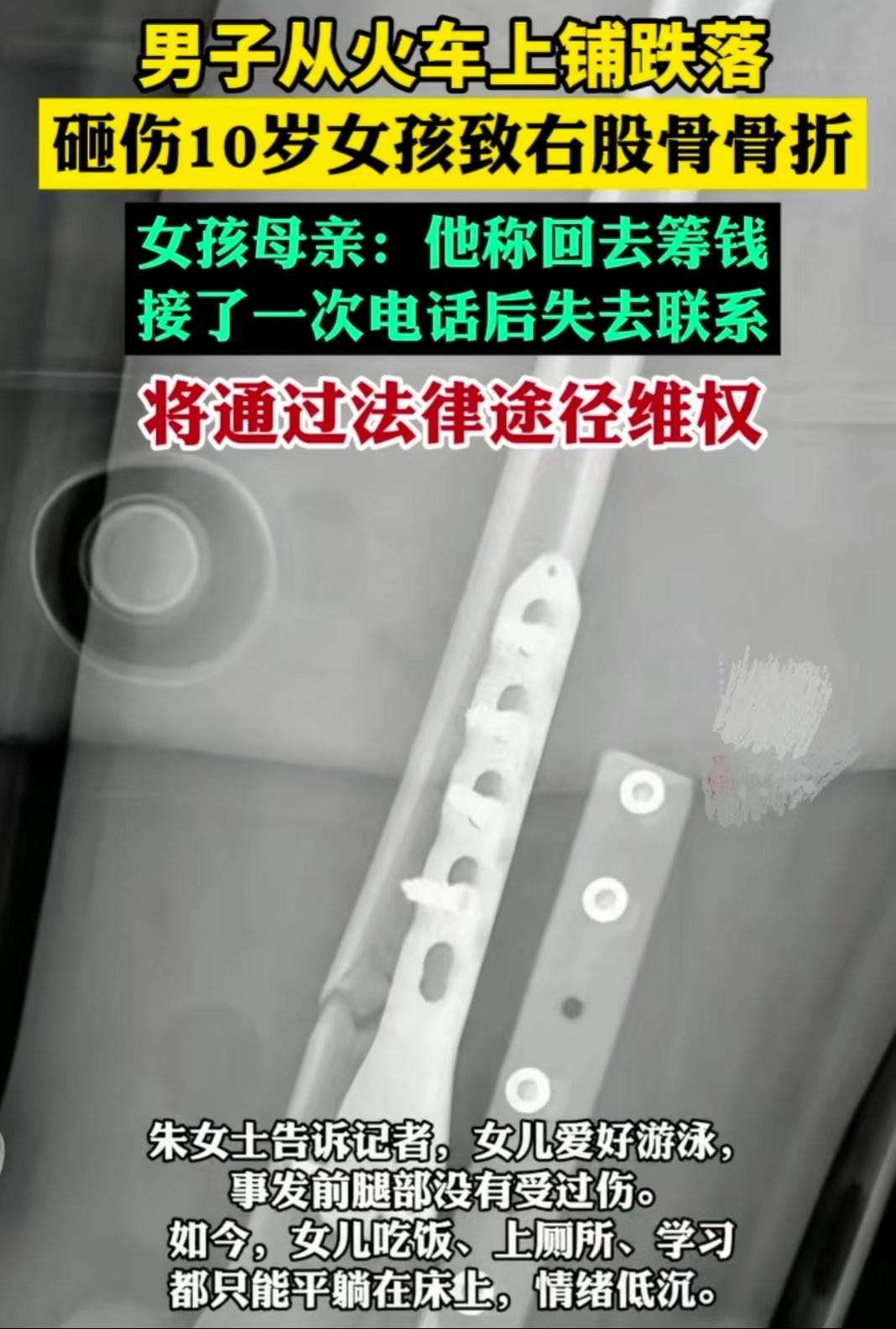 坐火车被砸伤，火车就真的安全吗？一10岁的女孩坐火车被一个男的从上铺掉下来砸伤