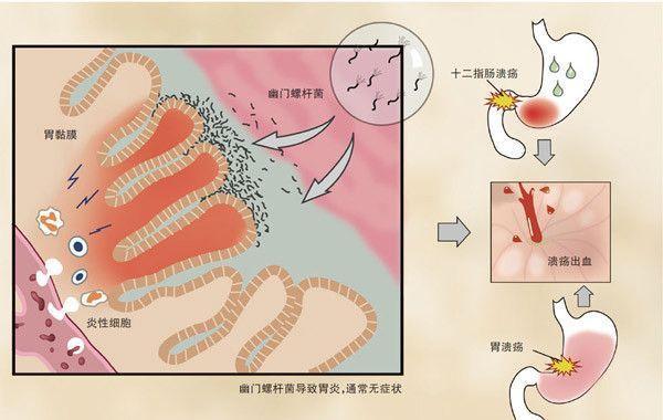 有口臭, 胃常肿痛、泛酸? 这几种情况要注意查幽门螺旋杆菌
