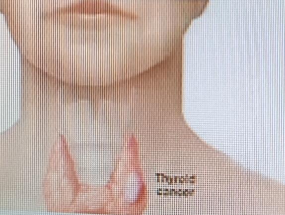 换季时，很多人会有喉咙异样感，觉得是小毛病，喝杯热水就不管了。但有些异常可能藏着