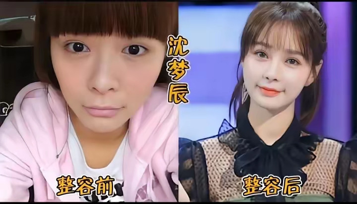 娱乐圈顶级医美成功范本说句大实话，沈梦辰的颜值，完全就是顶级医美塑造出来的。抛开天生的身高优势，她原