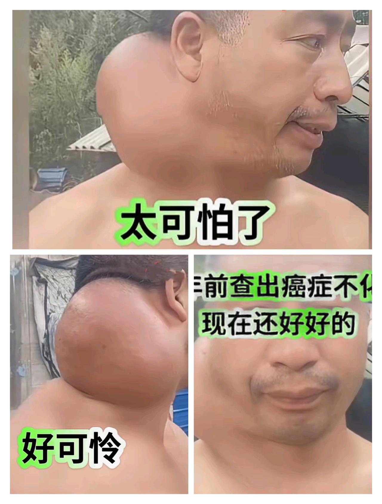 深圳一位大哥说，他15年前查出癌症，自从发现病之后，他坚持不化疗，不焦躁，总是保