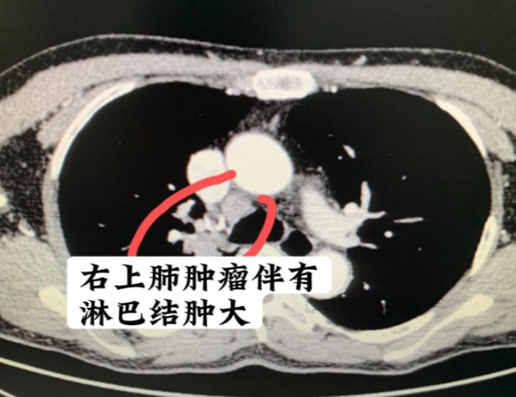 最终还是复发了，本来明明是有机会避免的……这位73岁的男患者，一开始是因为咳嗽、