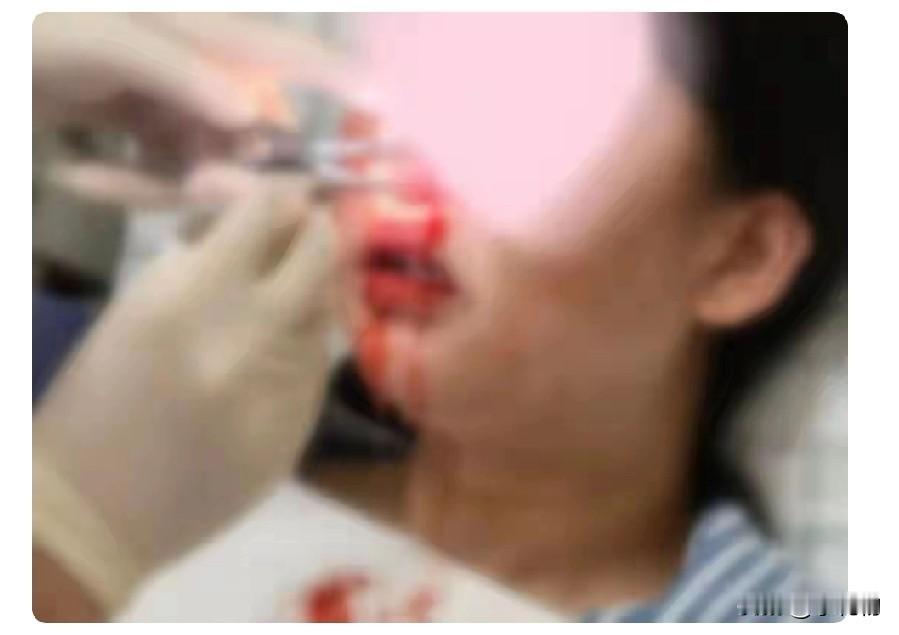 后怕！孕35周孕妈流鼻血，竟查出鼠药中毒😱深圳孕35周的邓女士突然流鼻血