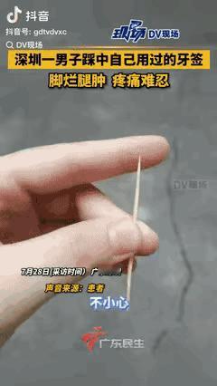 深圳王先生踩中自用牙签，脚底扎1公分小洞未出血，未处理。一周后脚底溃烂流脓，小腿
