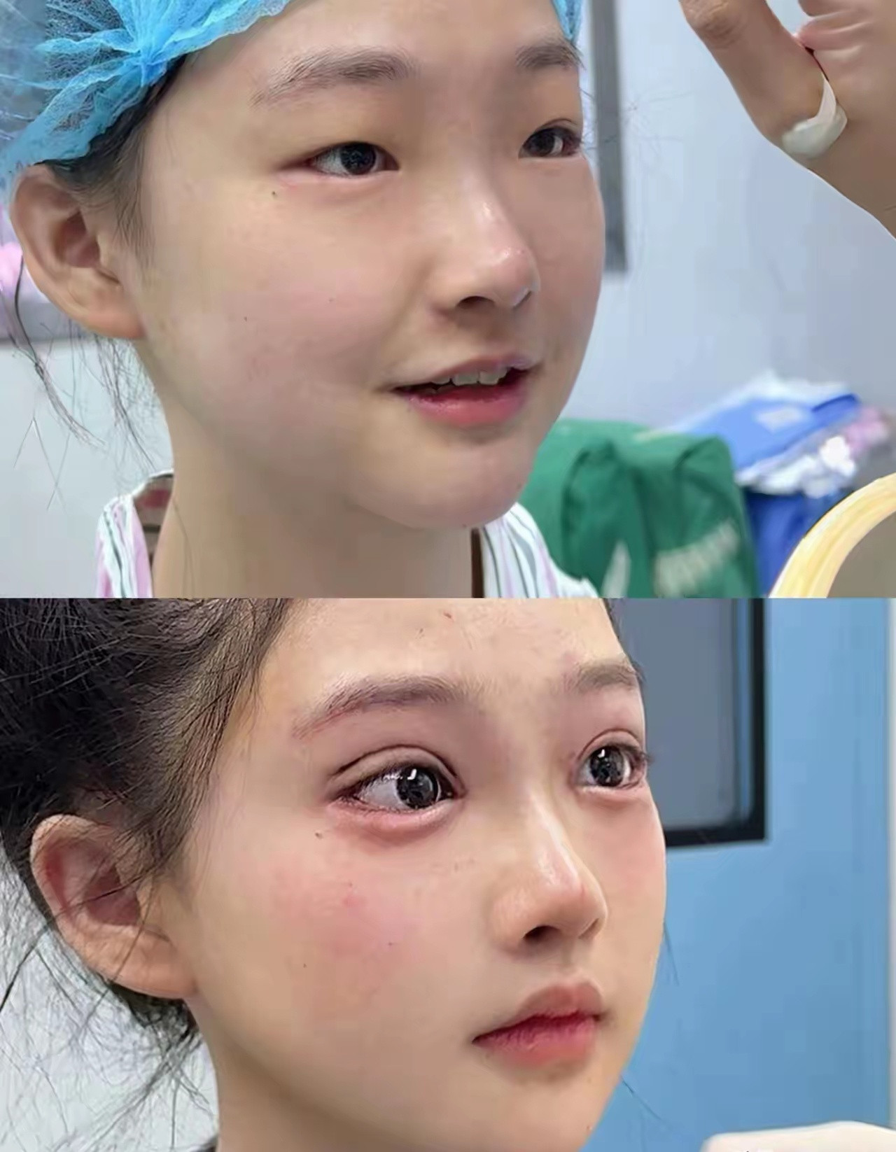 终于明白为什么那么多女生割双眼皮了。