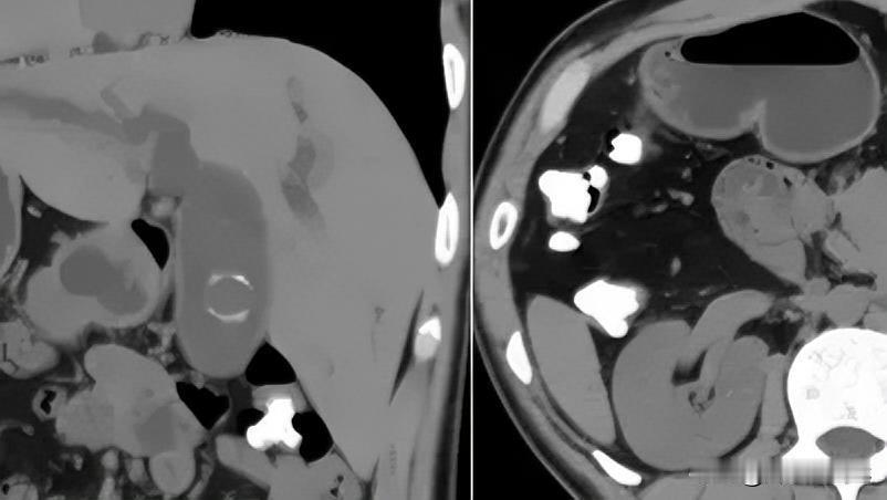 罕见！福建发现1例“镜面人”，医生：全球仅百万分之一！大家肯定不理解什么“镜面
