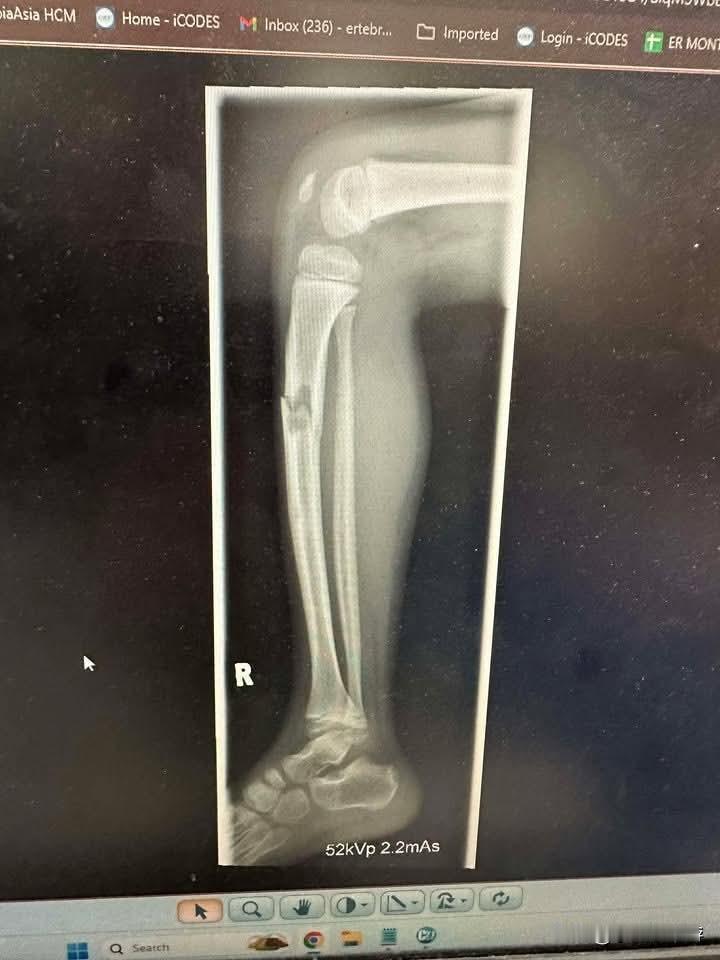 一名新加坡家长指控，孩子在马来西亚新山一间室内游乐场玩耍时不幸骨折，在孩子无法移