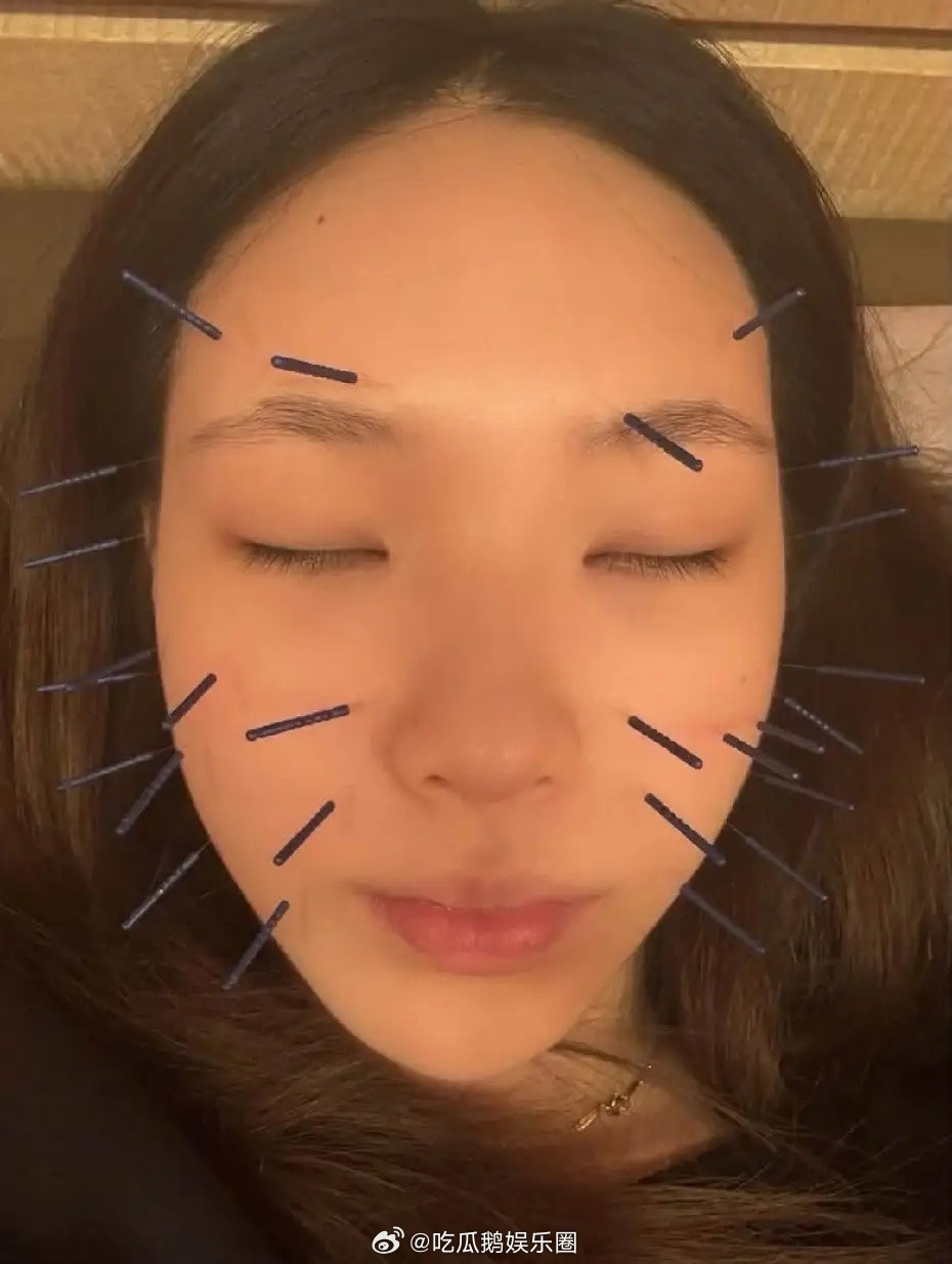 小S大女儿晒照，最近喜欢上拔火罐、针灸！有一说一，她还蛮真实的，她最近还上了妈妈