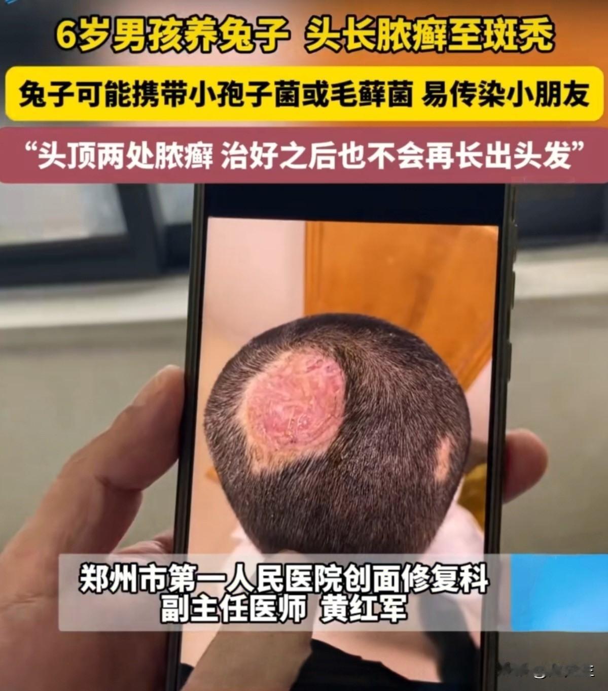 6岁男孩养兔子，染真菌永久秃发！看到这个新闻时，心里真是揪了一下——河南一个六