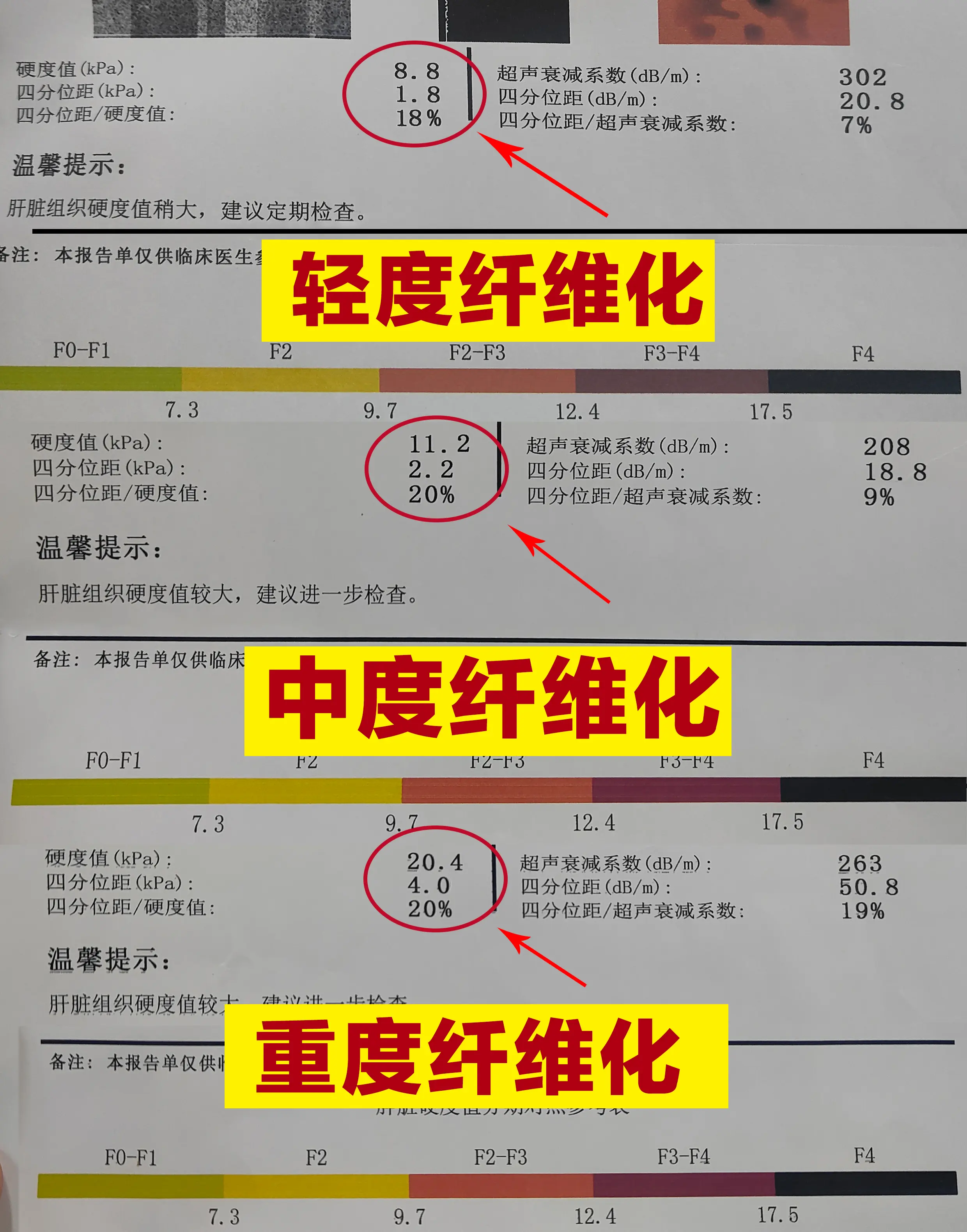 有朋友问我:“我肝弹26.7kpa是不是快挂了？”今天统一来回答这个问...