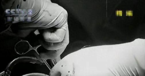 1995年，湖南人符桂林胸腔中弹后，被好心人送医后，医生始终没有找到那颗子弹。