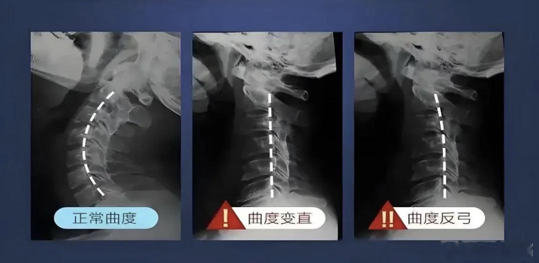 目前手机，除了眼睛，还有就是颈椎影响比较大，完全直立，或者，仰卧、躺卧可以改善压
