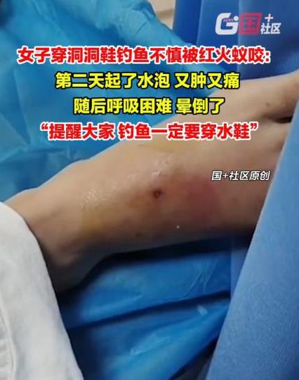 “太可怕了！”广东深圳，一女子穿洞洞鞋去和河边钓鱼，不小心被红火蚁咬伤，女子当时