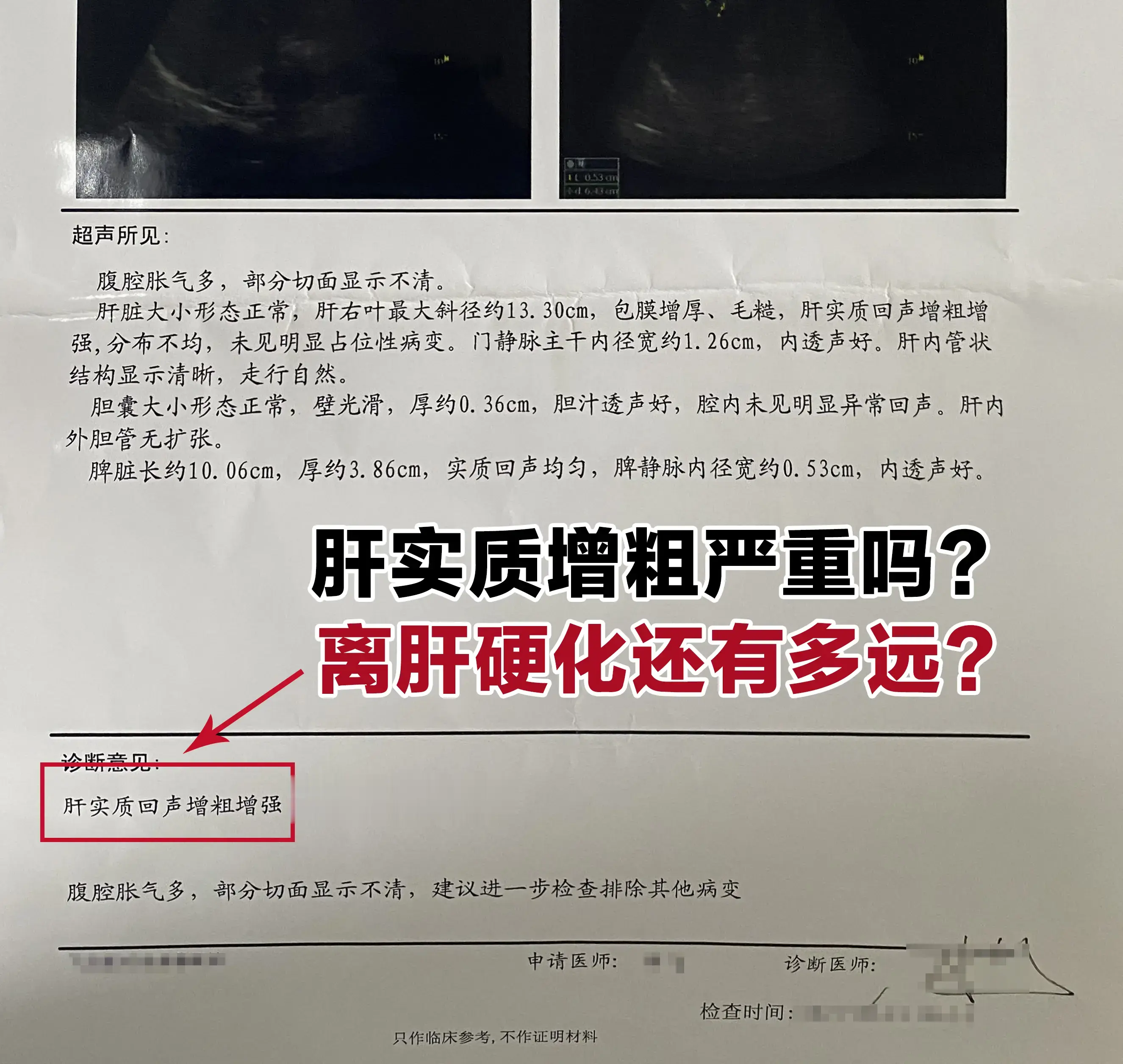 门诊常遇到患者拿着彩超单慌问：“肝实质增粗是不是快肝硬化了？”其实不用...