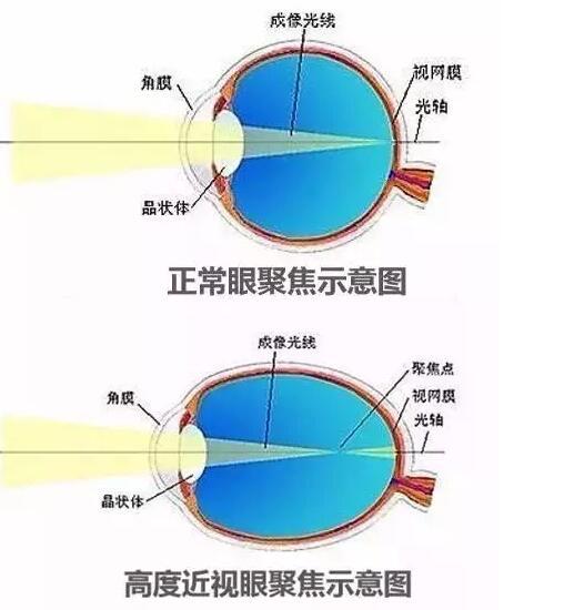近视600度以上的朋友可得小心了! 这些事儿最好别做