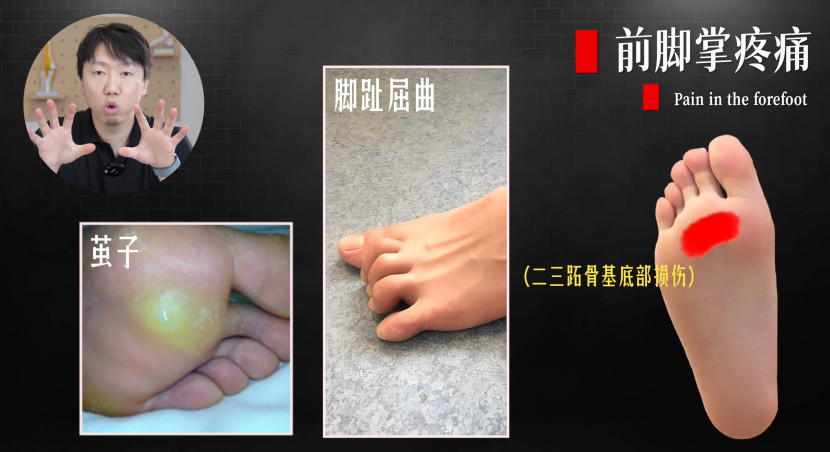 前脚掌疼痛大家在起床后，一踩地足底就出现疼痛，除了昨天讲的足底筋膜炎，还有【