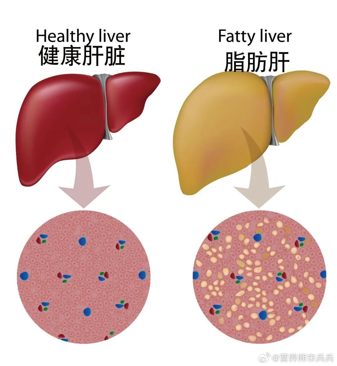 司美格鲁肽或能逆转脂肪肝健闻登顶计划为什么减肥能减轻脂肪肝？减少肝脏脂肪储存：