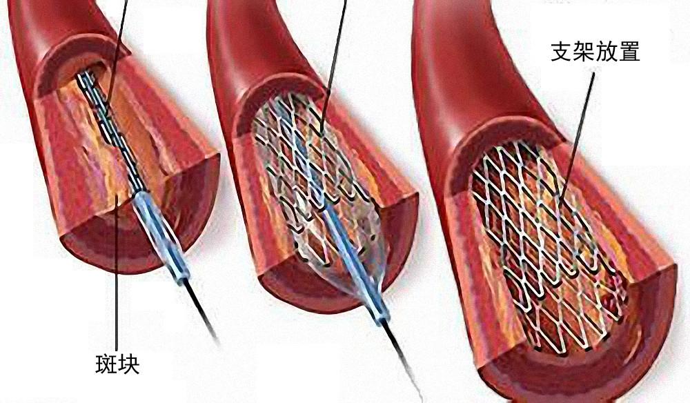 心脏支架能用几年？今天一位大爷出院时问我：“大夫，这前天做的心脏支架在里面能用