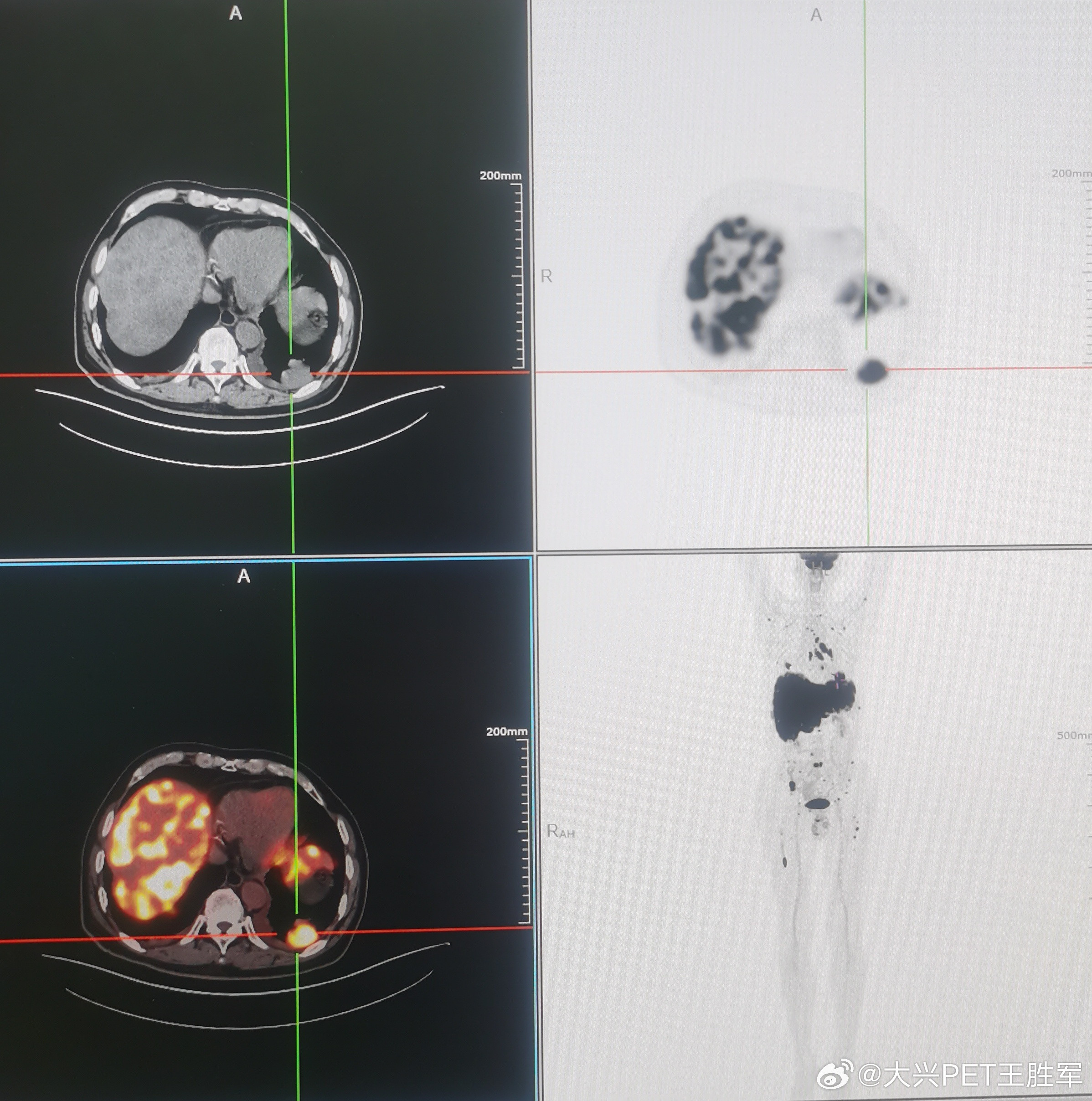 一例今天刚做的PET/CT患者:左肺下叶后基底段的3公分多的小细胞肺癌，没想到淋