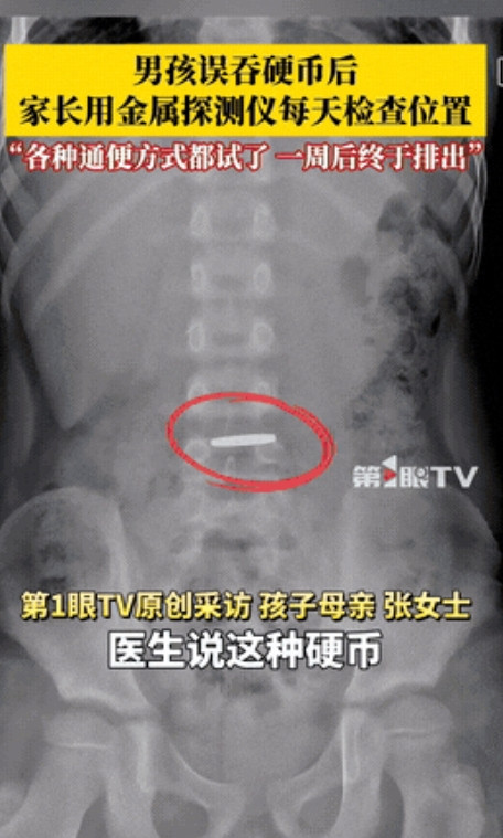 “太聪明了！”河南郑州，男孩不小心将一枚一元硬币给吞了下去，家长发现后立即带他赶