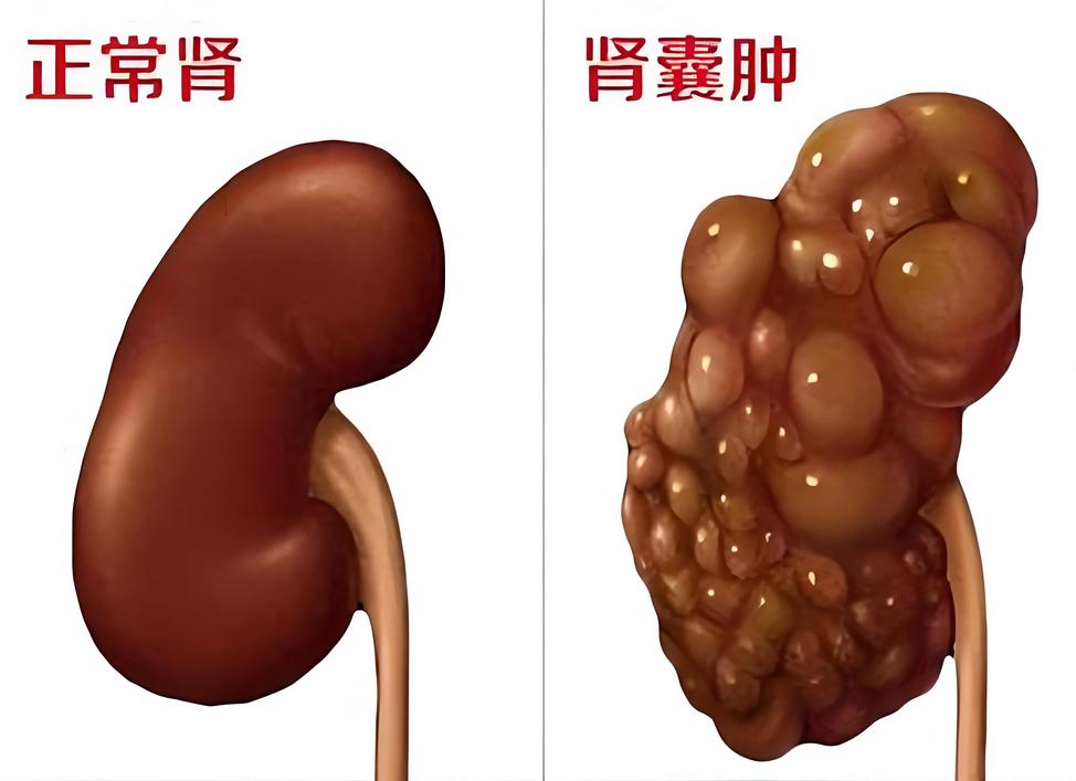 肾囊肿的