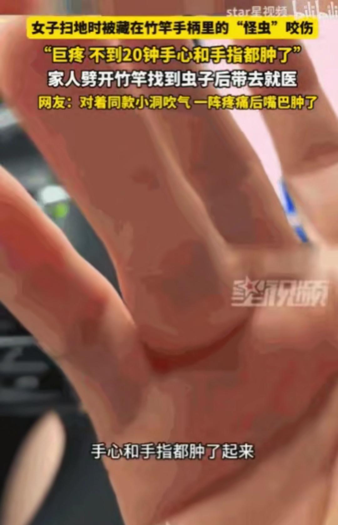 万万没想到！四川雅安，一位女子在家里扫地时，竟被扫把柄里窜出的一只“怪虫”狠狠咬