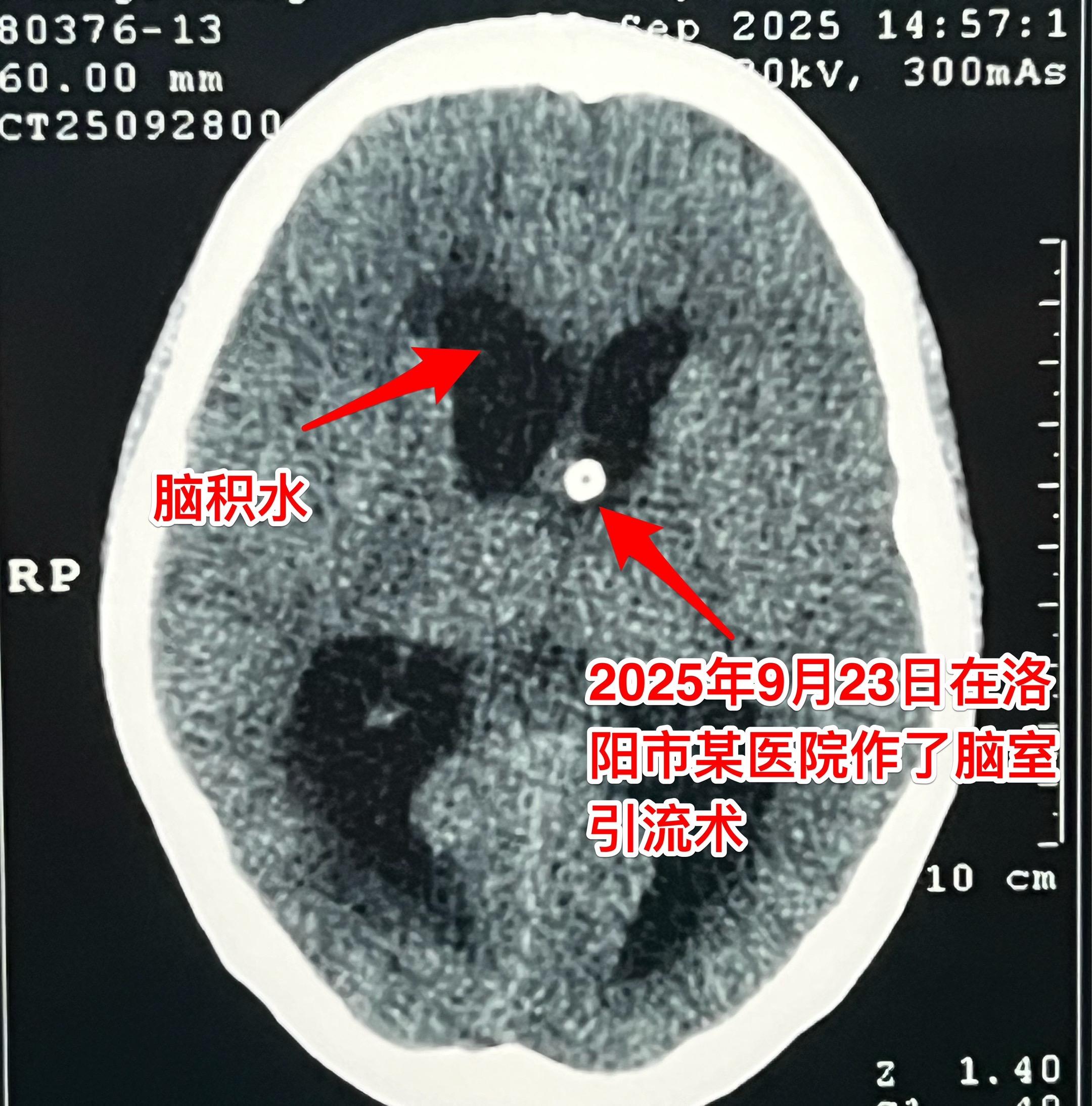 20岁女大学生生病三年身体虚弱如林黛玉。洛阳市女学生，三年前开始出现食...