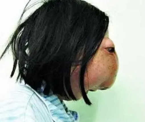 2009年，一名22岁浙江女孩因长了一张怪脸，被迫蒙面生活13年，当她好不容易凑