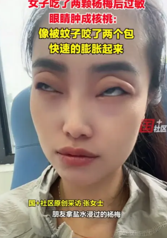 “笑不活了！”6月9日，湖北武汉，一美女吃了两颗杨梅后过敏，眼睛直接肿成“核桃”