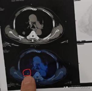 六旬老人肺结节拒绝手术，射频消融后半年，竟然出现了“脑转移”......一位60