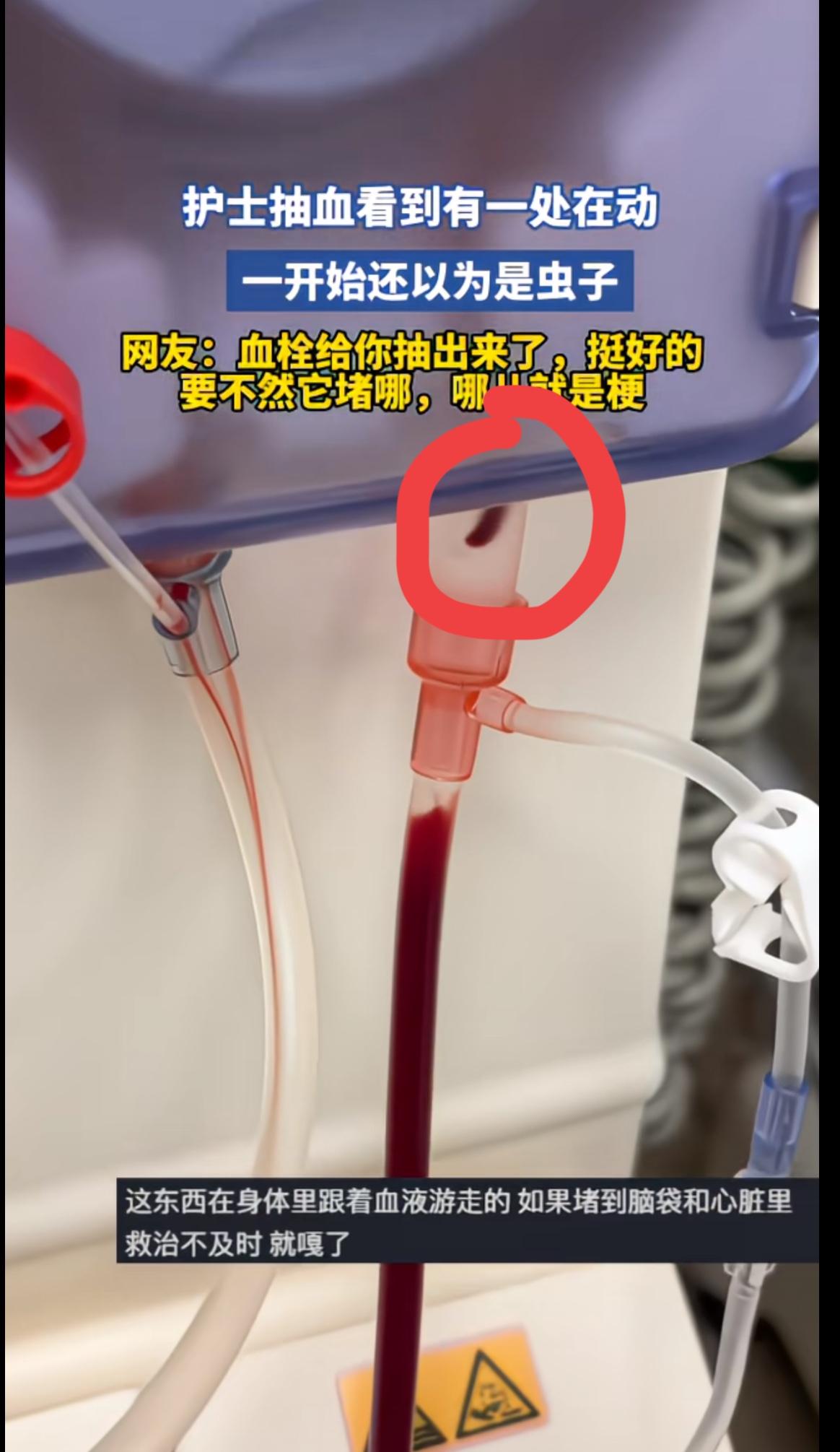 护士在给病人抽血的时候，发现抽血管里面有一个红色的东西在动的，还以为是虫子，仔细