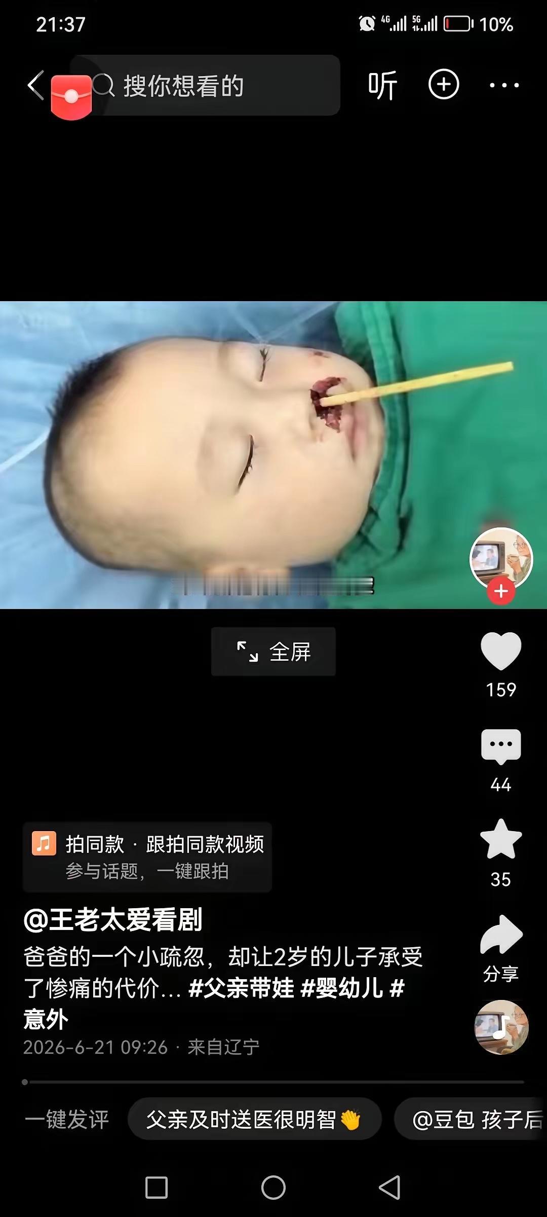 2岁宝宝独自拿筷子吃面，爸爸接电话疏忽一分钟，摔倒后筷子直插鼻腔，穿透筛窦刺入大