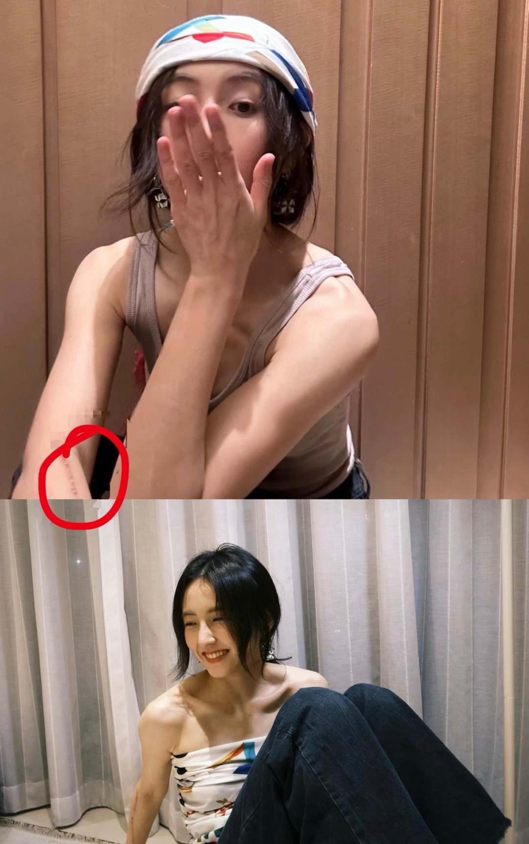 张子枫怎么受伤了，小臂一条那么长的伤痕