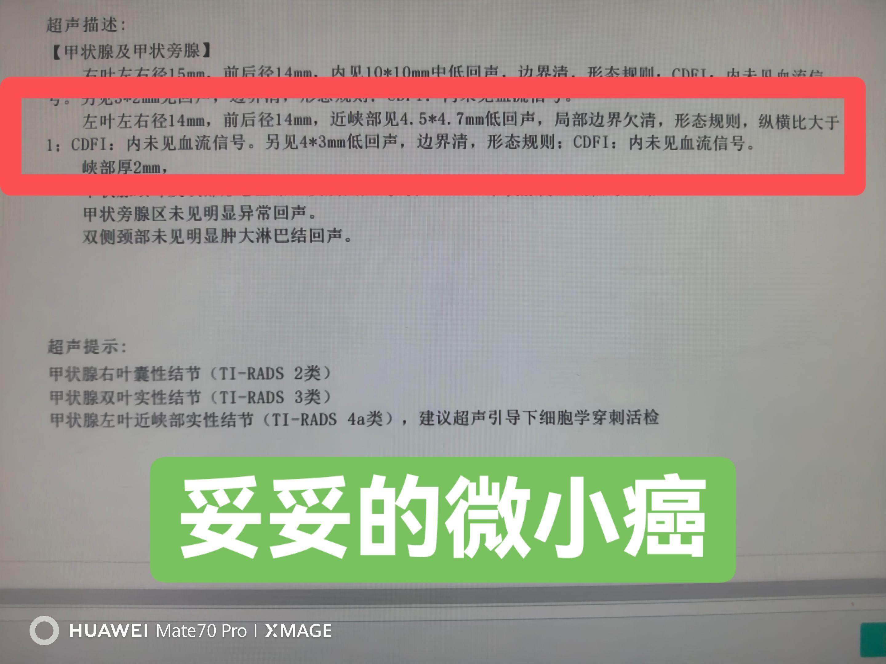甲状腺微小癌，不一定是懒癌。50余岁男性患者，发现甲状腺小结节直径约0...