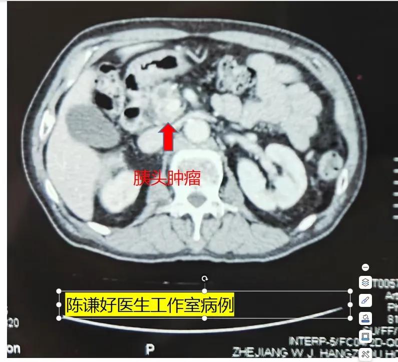 得了胰腺癌还有治疗的希望吗?胰腺癌虽然是一种恶性程度极高且预后较差的癌症，但并