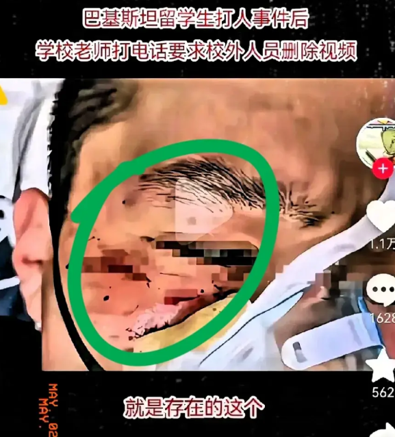 留学生有特权吗？无语了。江西理工大学某国留学生打伤本国学生，7天校方无回应。