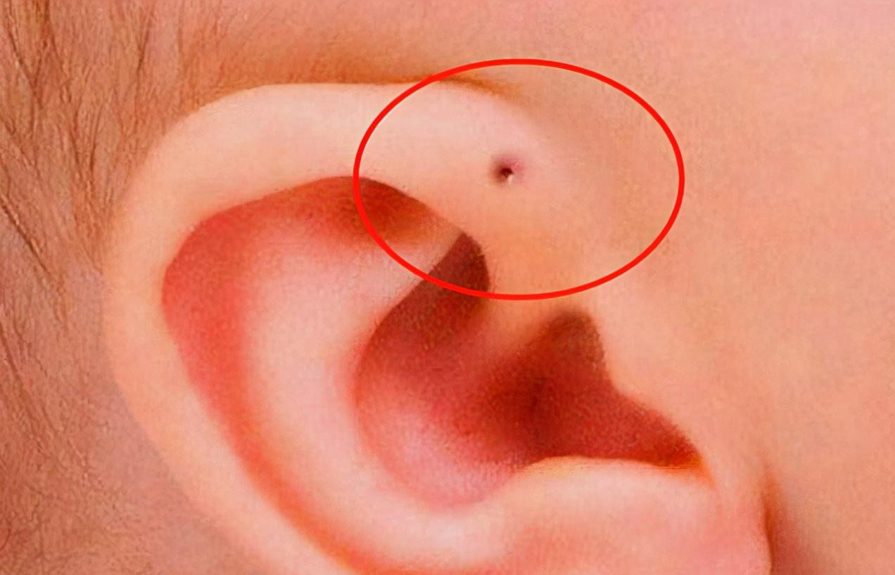 耳朵上的“小孔”不是痘痘！是颗定时炸弹！看到一则新闻六岁孩子因为耳朵那个小孔