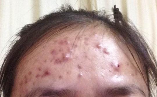 脸上这些部位长痘痘, 你的身体可能在向你求救!