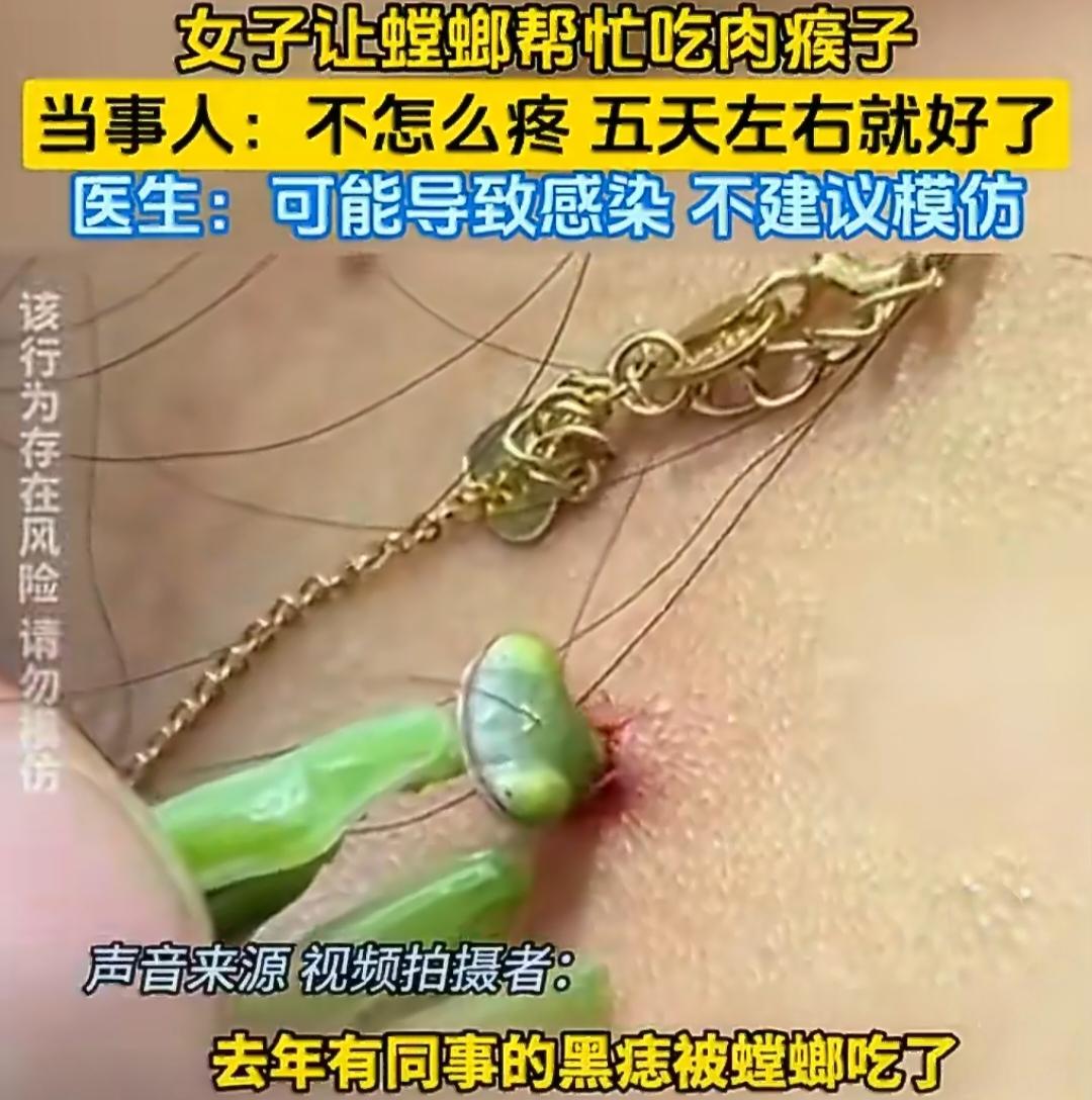 女子让螳螂“咬掉”自己脖子上的肉瘊子，医生急了！这事真的千万别模仿学啊！最