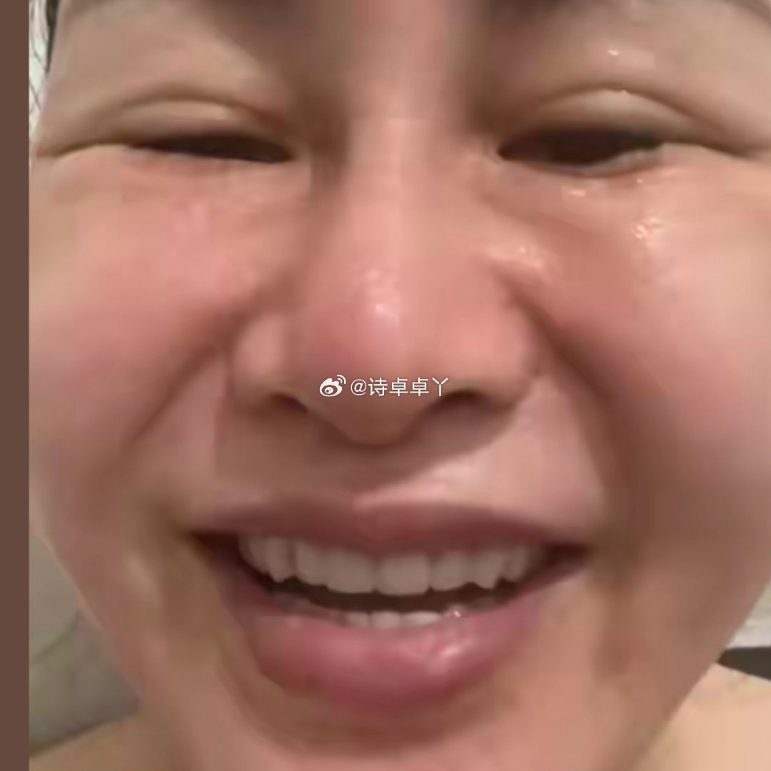 诗卓卓【馒化脸是什么】“馒化脸”即面部过度填充综合征，多因不当医美填充等