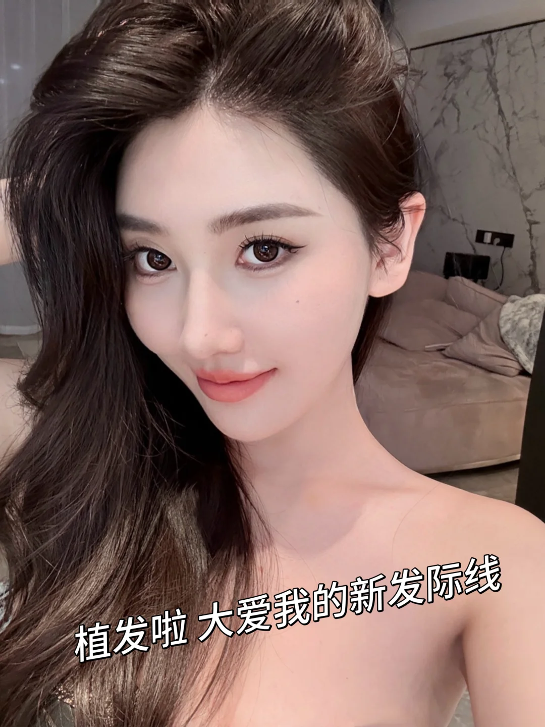 植发公开！终于对我的发际线下手了