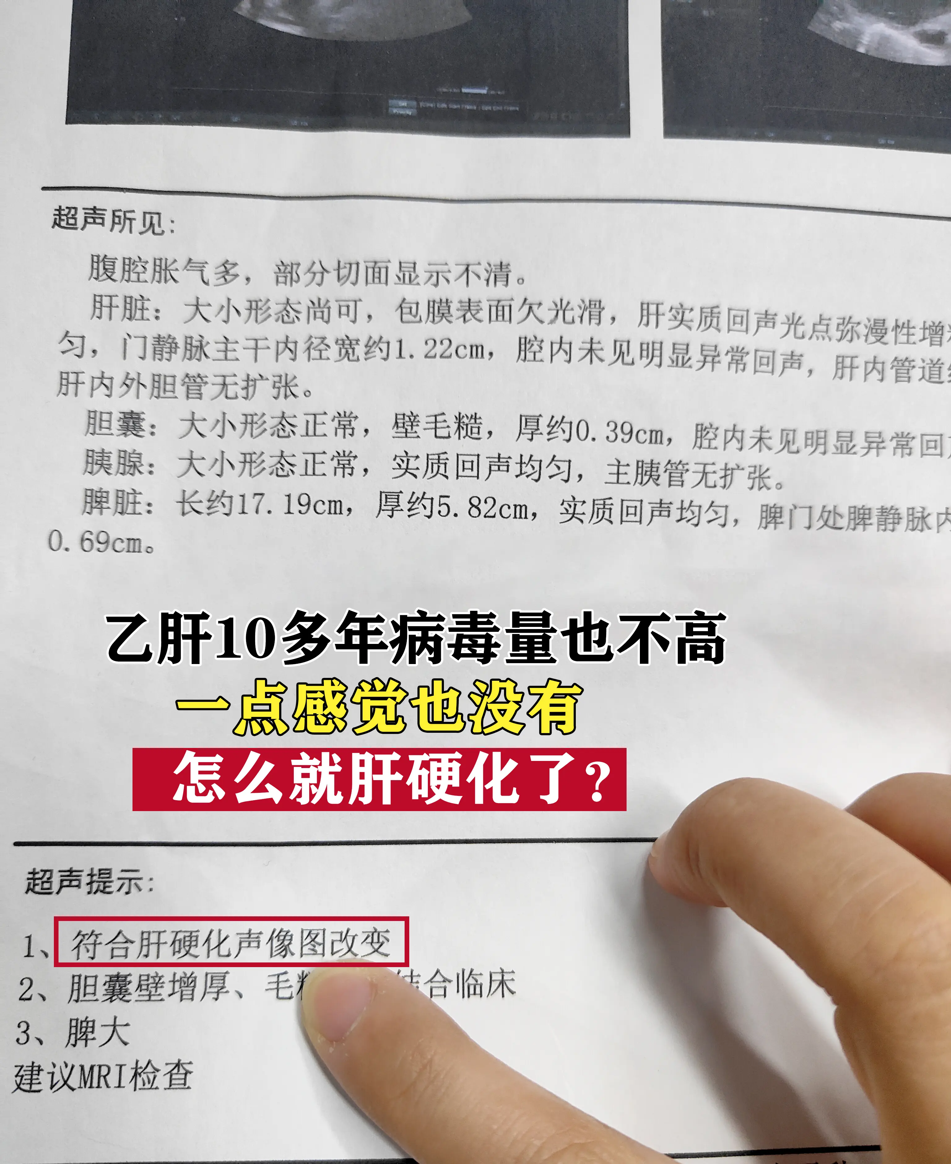 真的很可惜！。这位朋友是15年前体检查出乙肝，当时肝功能正常，医生说是...
