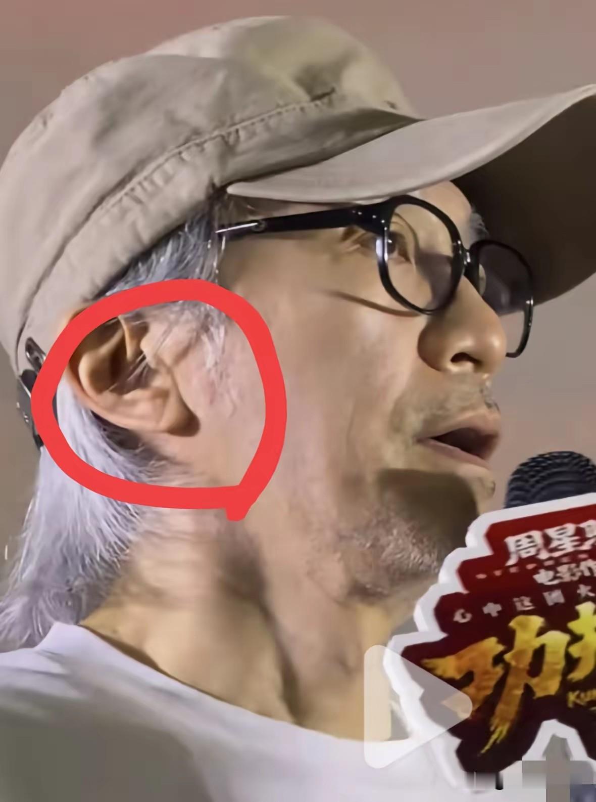 让人担心的事情还是发生了。眼尖的网友发现，这两次的路演，周星驰的耳朵出现了折痕！