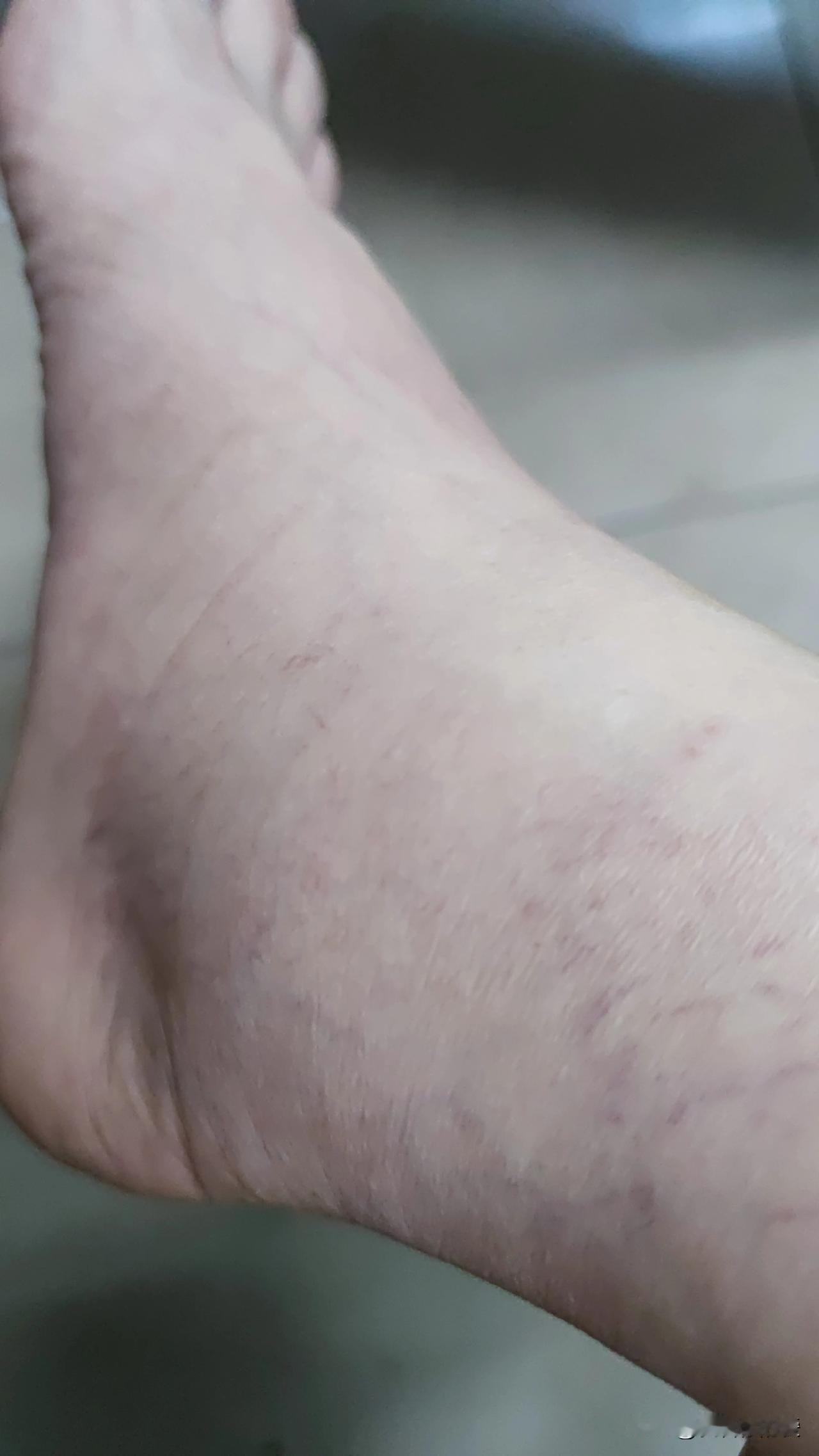 朋友在合肥美的洗衣机厂工作，一天要连续工作12个小时。长时间的站立，使得他的脚踝