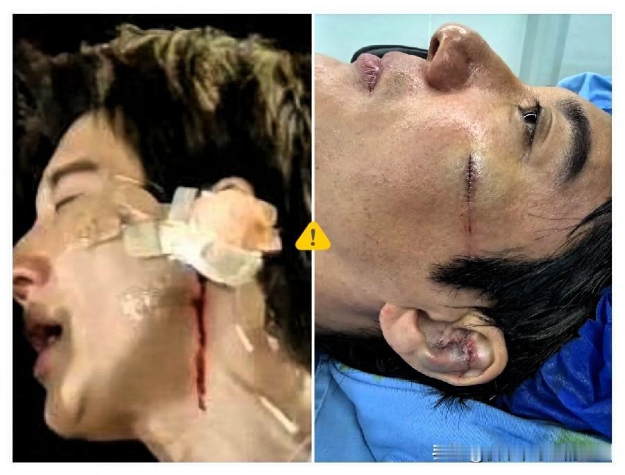 真是外行看热闹，内行看门道！我朋友是医生，他说王力宏演唱会绊倒磕伤耳朵，看着只