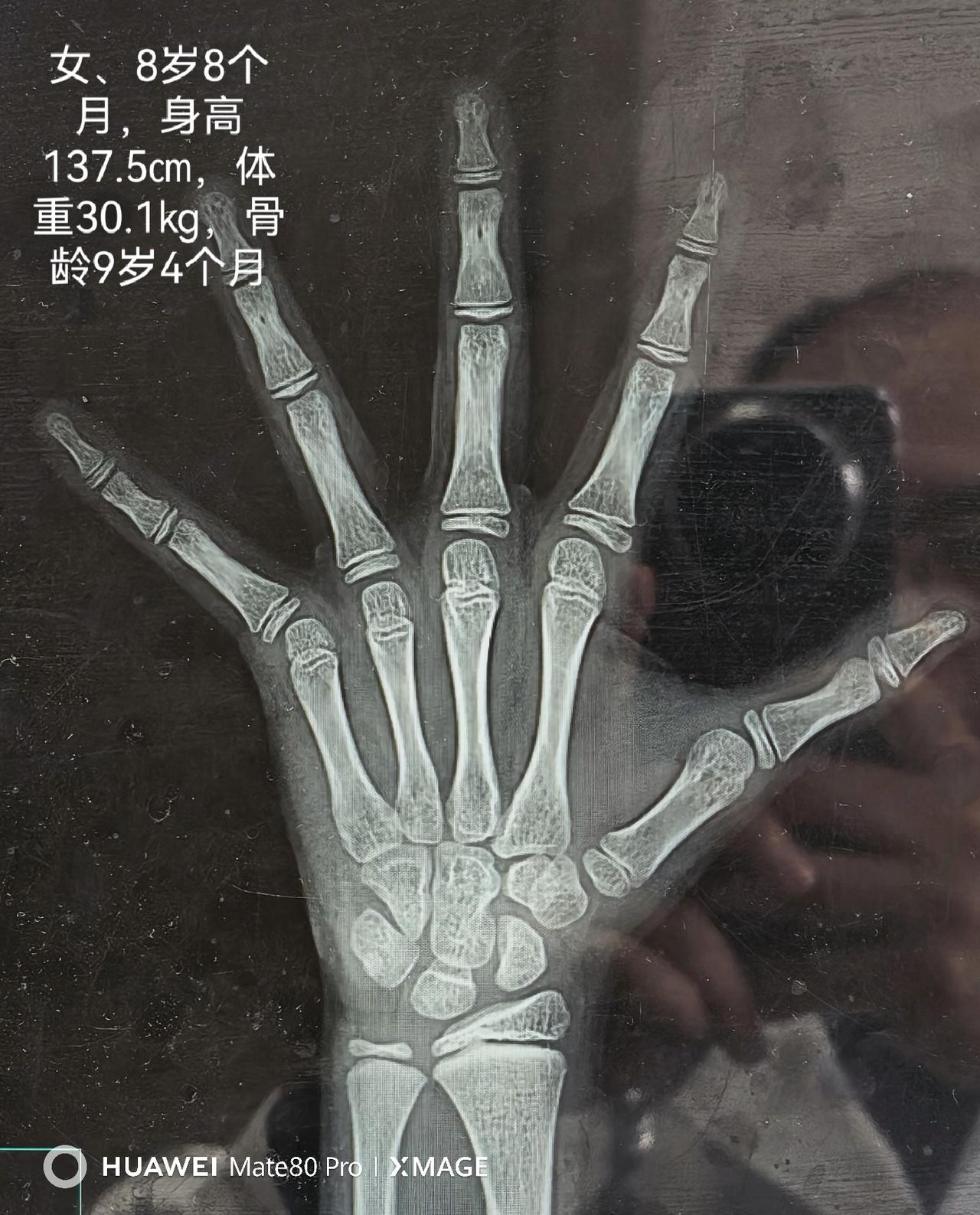 家有女宝的家长们，最近门诊遇到这类情况：8岁8个月出现乳房发育，骨龄仅超前几个月