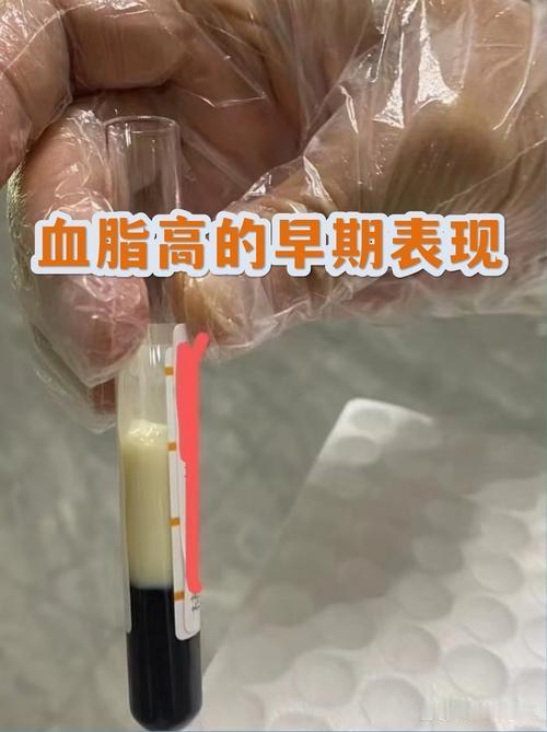 我身边好几个老伙计，平时都觉得自己身体硬朗，结果体检一查血脂高得吓人，还说自己没