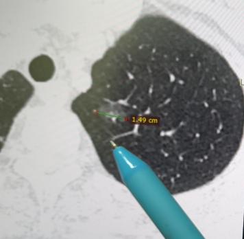 一位年轻小伙，5年前体检发现1.4cm的结节，一直在定期复查，直到今年报告提示，