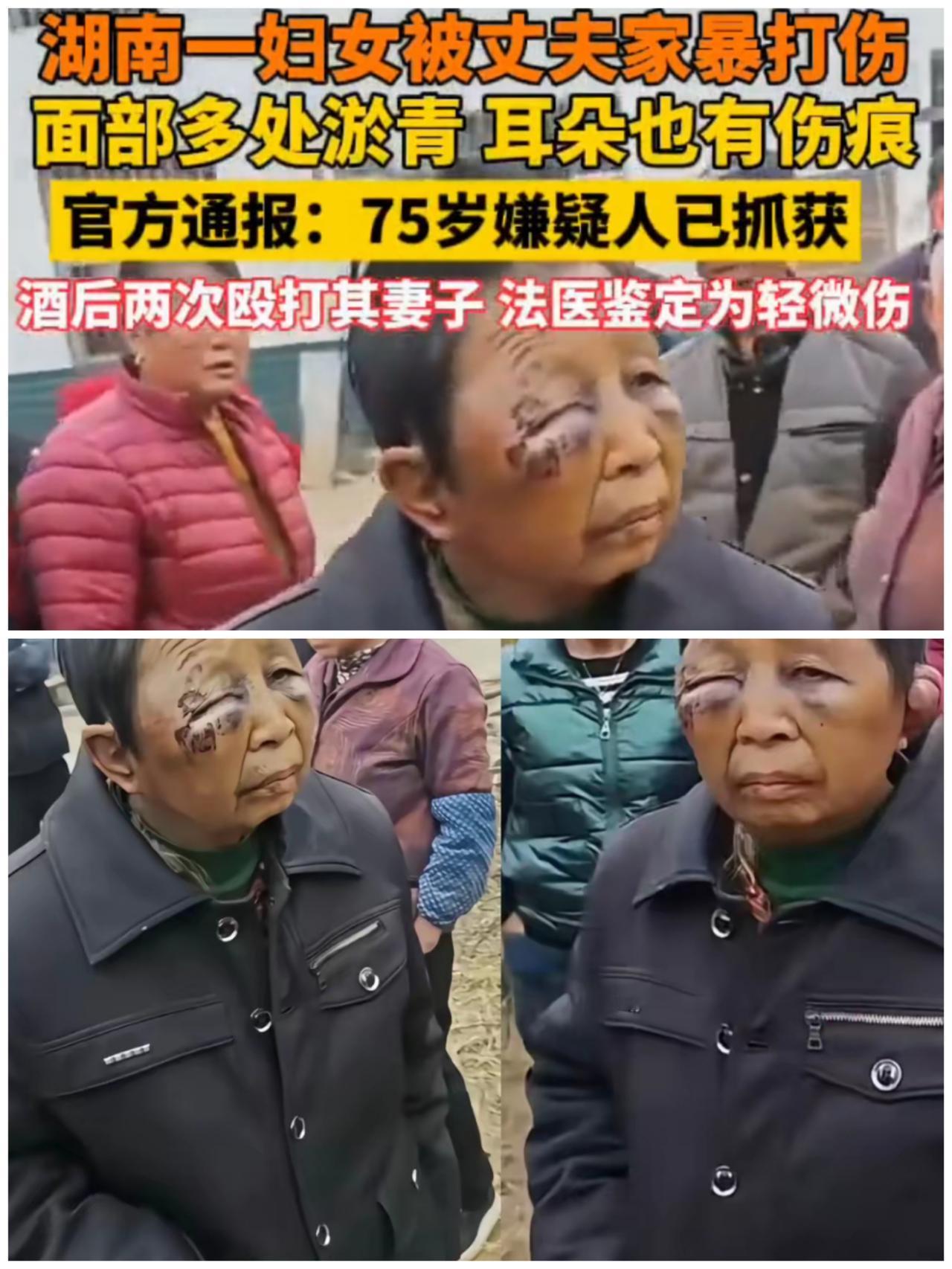 没想到啊！湖南平江遭丈夫殴打女子已经出院了，脸上这么严重的伤，在医院鉴定为表皮伤