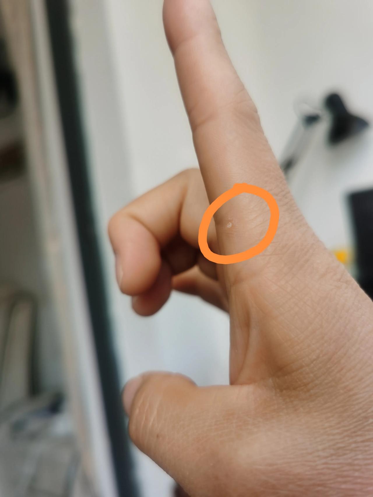 这是啥？已经两三年了，刚开始以为是湿疹的水泡，等着它自己消，等了两三个月，一直没